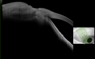 Advanced Visualization of Conjunctival Trabeculectomy Using Anterion