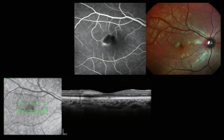 Spotlight Case: Early Diagnosis of MacTel Type 2 Using Multimodal Imaging with SPECTRALIS