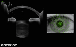 Visionary Case Study: Precision Ocular Imaging with Anterion by Toshbro