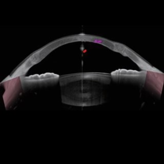 High-res Anterion image enabled precise assessment of residual stromal tissue post-surgery, aiding in effective monitoring of corneal stability.
.
Image Courtesy: Dr. Prabhat Nangia, Suraj Eye Institute, Nagpur.
