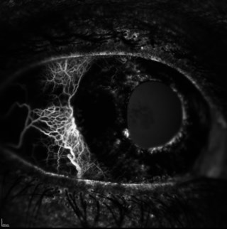 FA showing conjunctival vessels, multicolour image of venous beading in diabetic retinopathy, FA of corneal neovascularization, cilioretinal artery in FA, and “dead tree” CNVM on ICG angiography.
Kabiruddin Molla, AIIMS R.P. Centre, New Delhi
