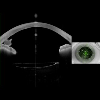 Anterion Imaging revealed a hidden nuclear fragment in the anterior chamber, missed on slit-lamp exam which showed only inferior corneal edema and bullae.
.
Image Courtesy:  Dr. Shilpa Kodkany, Belgaum.
