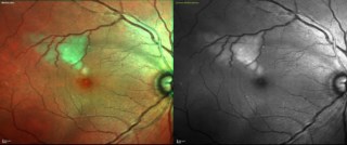 STROKE OF LUCK – MCI and green reflectance imaging on Spectralis, Heidelberg revealed an embolus in retinal microvasculature causing distal retinal whitening. Systemic evaluation uncovered cardiac disease, leading to timely treatment.
Dr. Karishm