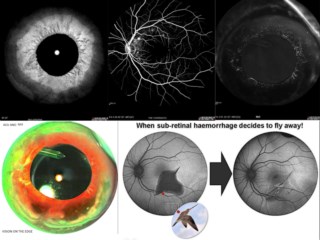 I hope this message finds you well.
I want to express my gratitude for considering me and choosing my image. I truly appreciate the opportunity. Spectralis can also detect iris atrophy, and I have many images of that.
Mr Rohit Gupta
