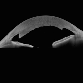 This is a case of a failed DSAEK showing edematous donor and host cornea.
Image Courtesy: Dr. Pooja Khamar,
Narayana Nethralaya, 
Bengaluru.