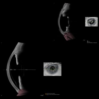 Anterion images show Descemet’s Detachment:
Image 1: mild corneal edema with visible detachment
Image 2: healed with attached Descemet’s membrane and reduced edema.
Image Courtesy: Dr. Amitava Biswas, Sunetra Family Eye Centre, Kolkata.