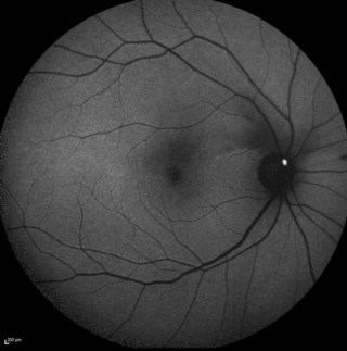 Title: The Plugging Plaque!
Legend: Blue Autofluorescence image using Spectralis captures a Hollenhorst plaque in a patient with an acute episode of hemi-central retinal artery occlusion.
Image Courtesy: Dr. Vishal Jadhav, LV Prasad Eye I