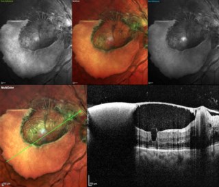 (A composite Multicolour fundus image along with Blue and Green Reflectance image and OCT scan of Sub ILM Hemorrhage in right eye)
Dr.Sengupta Sayantan
Sankara Nethralaya kolkata
