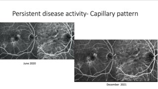 Identifying nAMD patients with persistent activity after initial anti-VEGF helps target high-risk cases for closer treatment and follow-up. Capillary patterns indicate better prognosis and are detected only by CSLO-based systems with precise tracking
