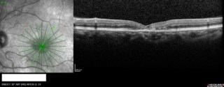 OCT of left eye in 59-year-old male with MacTel shows parafoveal thinning, hypo-reflective cavities, foveal thinning, and ellipsoid zone loss. FAF shows punctate hyperfluorescence. ELM disruption and inner retinal bowing are also seen.Mr. Pawan Kumar