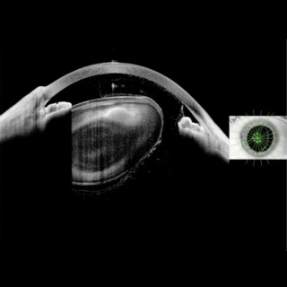 Cross-sectional image shows a subluxated natural lens in the anterior chamber with vitreous tongue prolapse touching the endothelium.
.
Image Courtesy: Dr. Kumar & Dr. Shivani, Doctor Eye Institute, Mumbai. 🏆 ASCRS 2023 Winner.