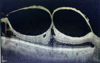 Spectralis detects subtle lesions like vitreomacular traction, allowing timely surgery to prevent permanent vision loss. It’s an excellent tool for close monitoring and ensuring the best outcome for patients.
Dr. Chaitra Jayadev, Narayana Nethralaya