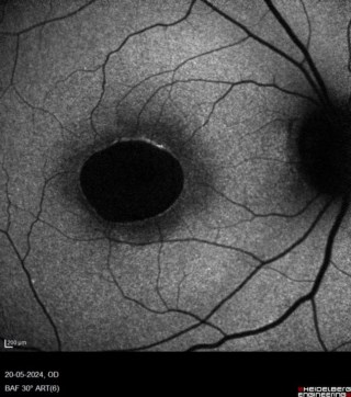 30°BAF image of Rod cone dysfunction
Mrs. Susmita Ghosh

