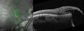 Structural OCT shows intraretinal silicon oil.
Mrs. GOURI DAS
