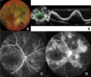 Multimodal imaging in a one-eyed young dengue patient shows multiple fluid pockets. OCT reveals undulating RPE with SRF. Early FFA shows pinpoint hyperfluorescence; late FFA shows dye pooling.
Dr. Sanghamitra Kanungo
