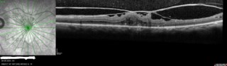 I was doing OCT and seen Left eye Vitreomacular Traction VMT and image quality so good.
Mr. anurag gupta
