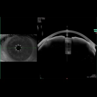 Anterion’s 1300nm swept-source OCT captured cilio-choroidal effusion with a wide 16.5 mm scan, providing detailed view from sclera to sclera.
Image Courtesy: Dr. Nitin Patel, Aashirwad Eye Hospital & Laser Center, Navsari.
