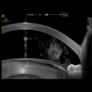 The above Image displays a case of Phacodonesis with vitreous in the anterior chamber and corneal touch.
.
Image Courtesy: Dr. Gaurav Luthra,
Drishti Eye Hospital, 
Dehradun.