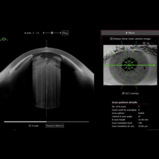 Anterion image shows a mature cataract with increased lens thickness and irido-corneal-lenticular touch—clarity comparable to UBM.
Image Courtesy: Dr. Gaurav Luthra, Drishti Eye Hospital, Dehradun.
