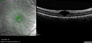 OCT image of Foveoschisis
Mrs. Susmita Ghosh
