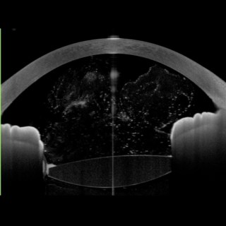 The above image displays a case of vitreous in anterior chamber. Anterion imaging confirmed the diagnosis of vitreous prolapse into the anterior chamber with extensive Vitreo-corneal touch.
Image Courtesy: Dr.Amitava Biswas,
Sunetra Family Eye Centre