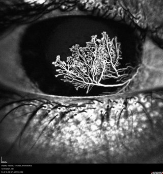 Cilioretinal artery in FA, Corneal neo-vessels in FA, conjunctival vessels in FA and venous beading in diabetic retinopathy in multi colour imaging respectively
Mr. KABIRUDDIN MOLLA
