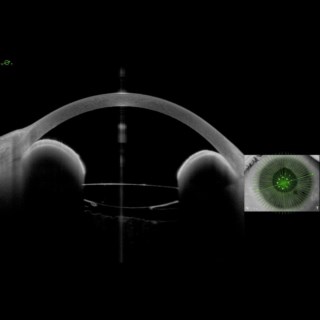 This is a case of IRIS Bombae with 360-degree closure and an image of the same patient post Iridotomy showing complete opening of all angles.
.
Image Courtesy: Dr. Sachin Mungale,
Mungale Eye Hospital, 
Vadodara.