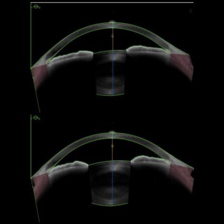 Anterion Metrics App shows anterior chamber changes in the same eye:
Image 1 (light adapted): constricted pupil, narrow angles, shallow ACD
Image 2 (dark adapted): dilated pupil, closed angles, shallow ACD.
Image Courtesy: Dr. Manish Shah, Foresight 