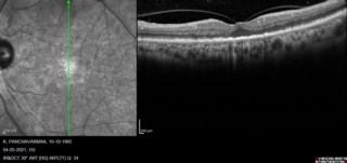 Mr. Panchavarman’s LE shows VMT with altered foveal contour. Mrs. Leela’s RE shows subfoveal serous detachment with subretinal PPT and pachy vessels (CSC). Mrs. Shanthi’s RE shows CNVM Type 2 (MNV) with SRF.
Dr. Saravanan Jothi, CMCH
