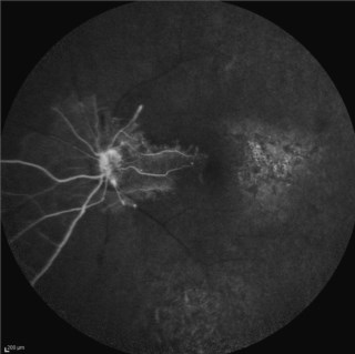 Case of Viral retinitis involving fovea with extensive occlusion seen in fluorescein angiography.
Dr.GAYATHRI M S
