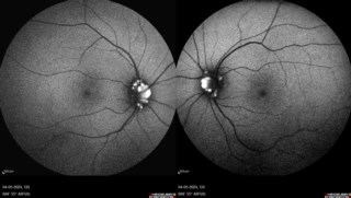 **BILATERAL OPTIC DISC DRUSEN** – Fundus Autofluorescence (FAF) of both eyes shows optic disc drusen as highly autofluorescent, making FAF an excellent tool for their identification.
Dr. Shivani Chhabra
EYE7 Hospital, New Delhi