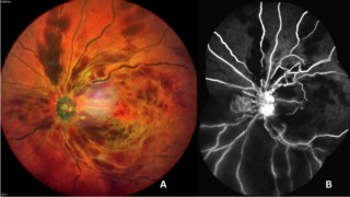 Multimodal imaging shows dot-blot hemorrhages with dilated tortuous veins in all quadrants. FFA reveals capillary nonperfusion and disc neovascularization resembling a “dancing spider” — ischemic CRVO.
Dr. Sanghamitra Kanungo
