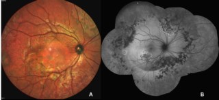 Multicolour photo shows grey-white lesions around the posterior pole in TB-associated serpiginous choroiditis. Autofluorescence reveals active (hyper) and healed (hypo) areas, aiding follow-up.
Dr. Sanghamitra Kanungo
