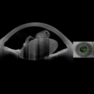 This is a case marvellous case of a traumatic dislocation of the lens. We could clearly see that it has ruptured the capsule and has lodged into the anterior chamber.
.
Image Courtesy: 
Dr. Ashok Kumar Nanda, 
Kar Vision Eye Hospital,
Bhubaneshwar.