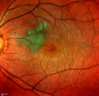 Multicolour composite image showing Paracentral Acute Middle Maculopathy.
Mrs. GOURI DAS

