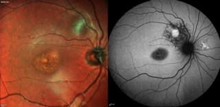 CONVERGING AT THE CROSSROADS – MCI and FAF imaging on Spectralis, Heidelberg in a case of Stargardt disease (inherited) with a healed granuloma (acquired). FAF confirmed lesion inactivity, indicating no need for treatment.
Dr. Karishma Tendulkar,