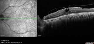 OCT image of VMT with ERM.
Mrs. Susmita Ghosh
