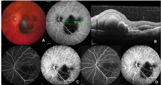 Multicolour image shows intraretinal bleed. OCT reveals thumb-like notched PED. Mid-phase ICG shows hyperfluorescent polyp near macula. Late ICG confirms growth, highlighting ICG’s role in PCV diagnosis.
Dr. Sanghamitra Kanungo
