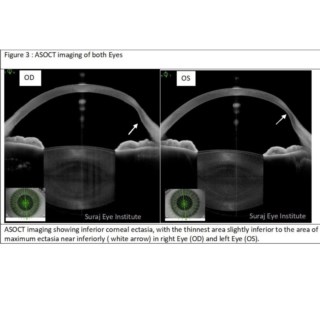 This is a classic case of Topography Data validated simultaneously by the structural imaging in Anterion. Here, PMD is detected very conclusively as seen above.
.
Image Courtesy: Dr. Prabhat Nangia,
Suraj Eye Institute,
Nagpur.