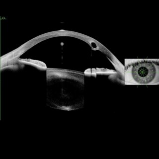 Anterion image shows a keratoconus eye with an intrastromal Intacs segment, clearly displaying insertion depth and surrounding tissue.
Image Courtesy : Dr. Shivani Patnaik, Doctor Eye Institute, Mumbai.
