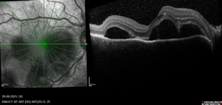 MULTIPLE SEROUS DETACHMENT POST FEBRILE UVEITIS
Dr. SATHYAN P
