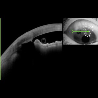 This image confirms that the implanted Ahmed Glaucoma Valve tube does not touch the cornea. Anterion allowed me to perfectly visualise the non- central areas of the eye too.
.
Image Courtesy: Dr. Manish Shah,
Foresight Eye Centre,
Mumbai.
