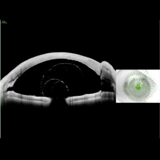 This image captures a vitreous prolapse in a pseudophakic eye post-trabeculectomy, creating a striking "balloon illusion" in the anterior chamber, nearly touching the endothelium. Image courtesy: Dr. Kumar Doctor, Doctor Eye Institute, Mumbai.