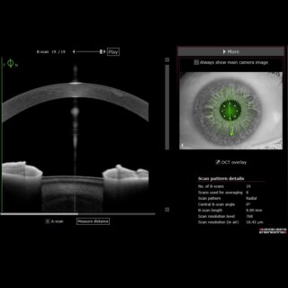 High-resolution Anterion image reveals corneal scarring, clearly visualizing even nebular scars.
Image Courtesy: Dr. Gaurav Luthra, Drishti Eye Hospital, Dehradun.
