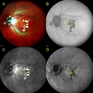 Fundus image shows new lesion (yellow circle). Blue autofluorescence fails to detect it. Infrared image delineates it, while IR autofluorescence shows activity via hyper-autofluorescent border.
Image Courtesy: Dr. Vishal Jadhav, LVPEI.
