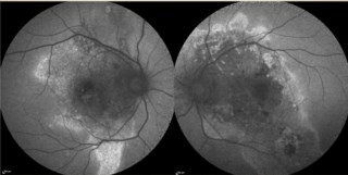 Pauleikhoff et al described 3 CSC types: uni-FISH, multi-FISH, and DISH. This DISH case shows PCRD, indicating poor prognosis. PCRD with SRF leakage responds well to half-dose PDT.
Dr. Ashraya Nayaka, The Eye Foundation, Coimbatore