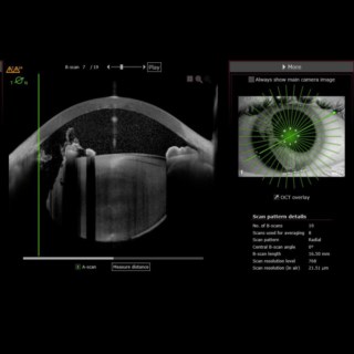 This was a case of traumatic Irido-Dialysis. Thanks to the highly sensitive Imaging App, the Vitreous Hoop, Cells and Flare in the Anterior Chamber, were visualized clearly.
.
Image Courtesy: Dr. Gaurav Luthra,
Drishti Eye Hospital, 
Dehradun.