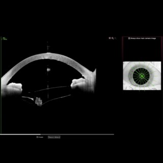 Post-op Anterion image shows retained epinucleus behind PCIOL with no escape route, causing inflammation and posterior capsule indentation.
.
Image Courtesy: Dr. Kumar Doctor, Doctor Eye Institute, Mumbai.