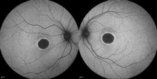 THE ECLIPSE WITHIN: STARGARDTS SILENT SHADOW
Fundus autofluorescence image of a patient with stargardts disease.
Dr. Karishma Tendulkar
