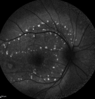 Blue autofluorescence image showing multiple hyperautofluorescent deposits in a case of Best's disease.
Mrs. GOURI DAS

